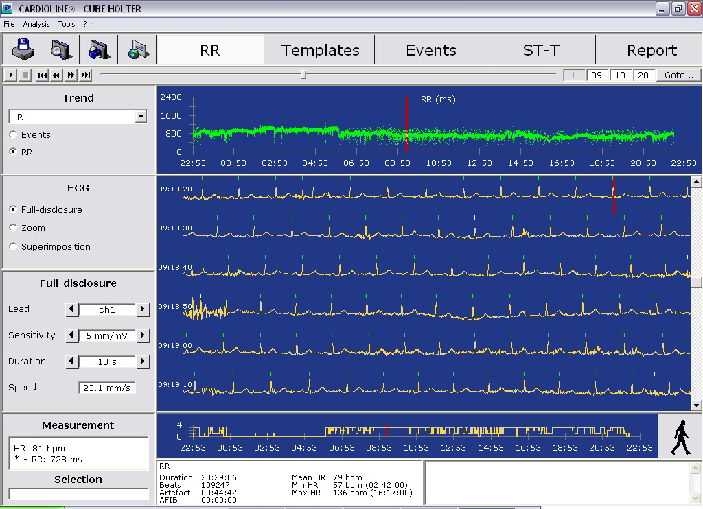 Holter monitor is a continuous tape recording of a patient\'s ECG for 24 hours.